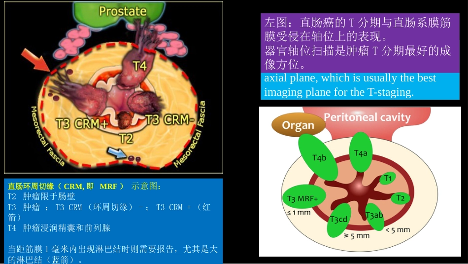 直肠癌：MRI与临床_第12页