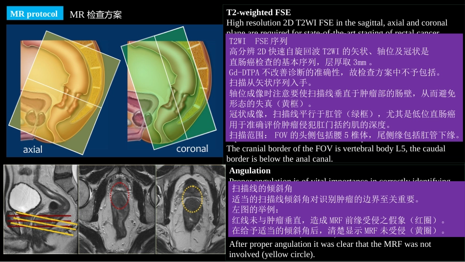 直肠癌：MRI与临床_第15页
