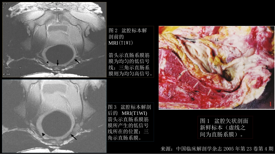 直肠癌：MRI与临床_第5页