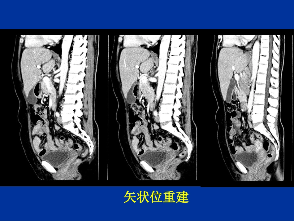 胆道疾病的影像学诊断_第10页