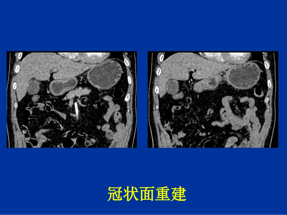 胆道疾病的影像学诊断_第11页