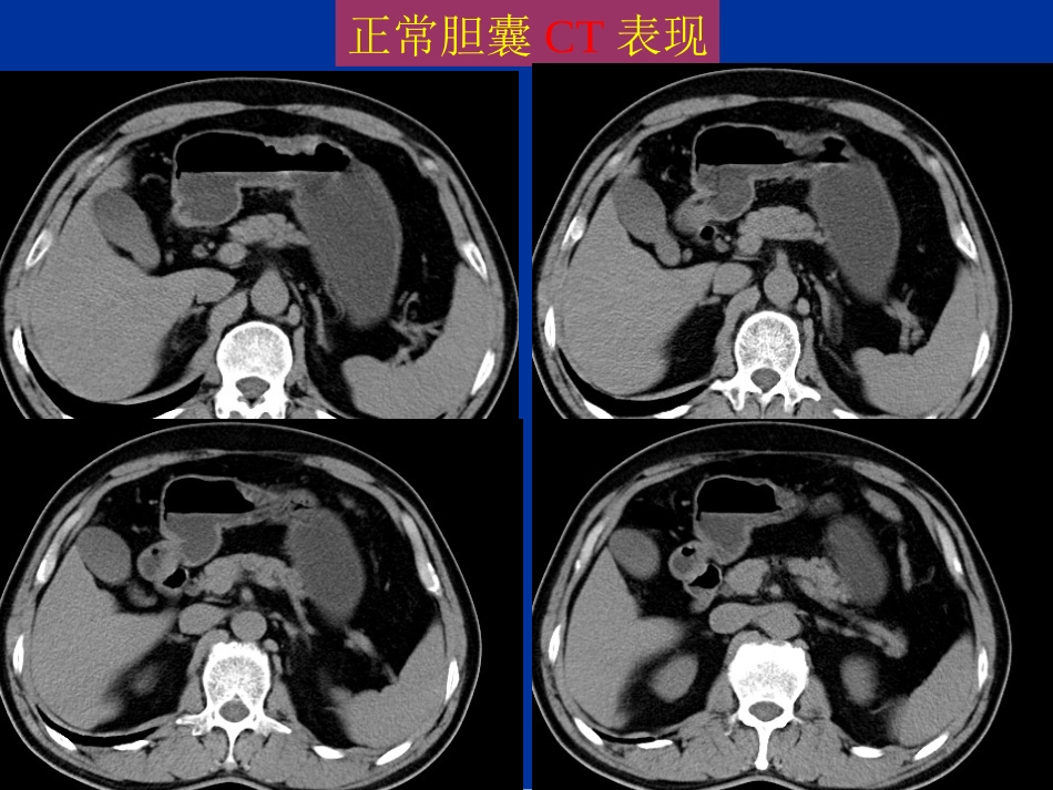 胆道疾病的影像学诊断_第9页
