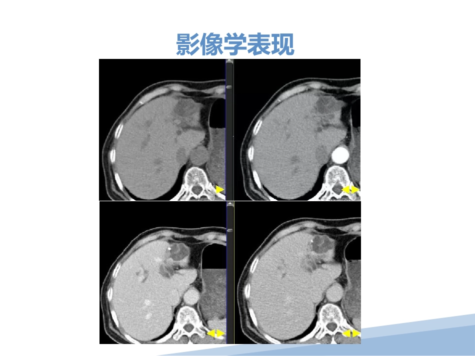胆管细胞癌胆管癌影像诊断_第10页