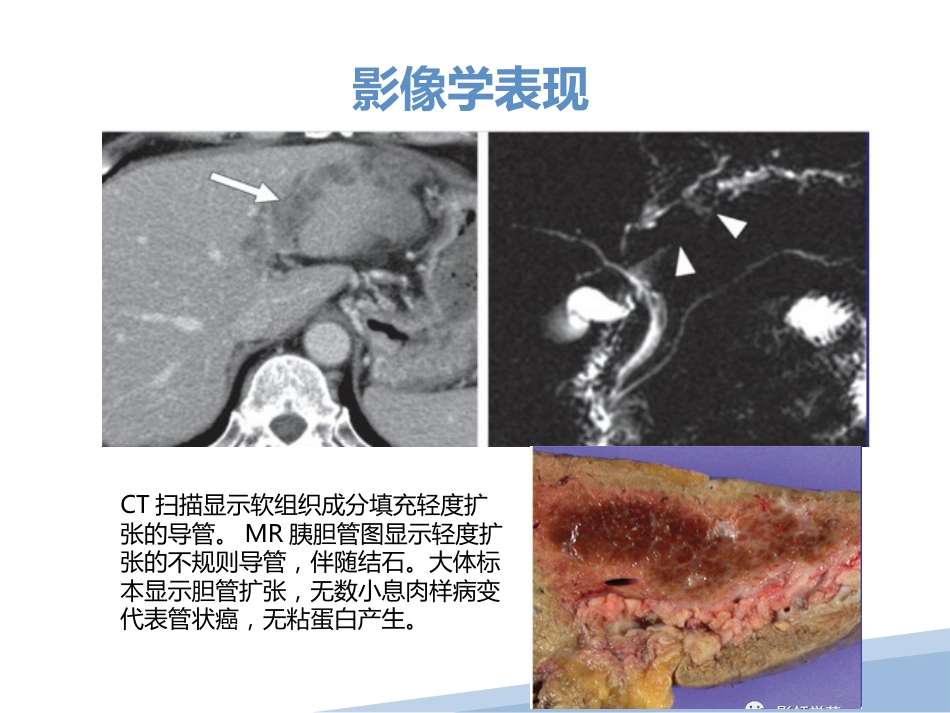 胆管细胞癌胆管癌影像诊断_第12页