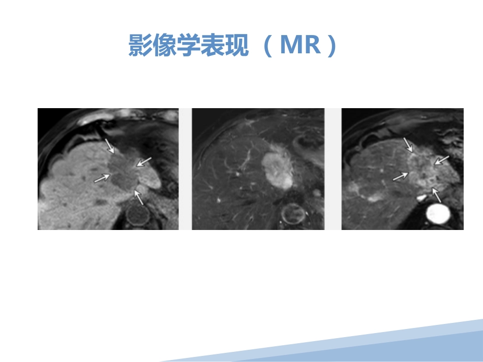 胆管细胞癌胆管癌影像诊断_第14页