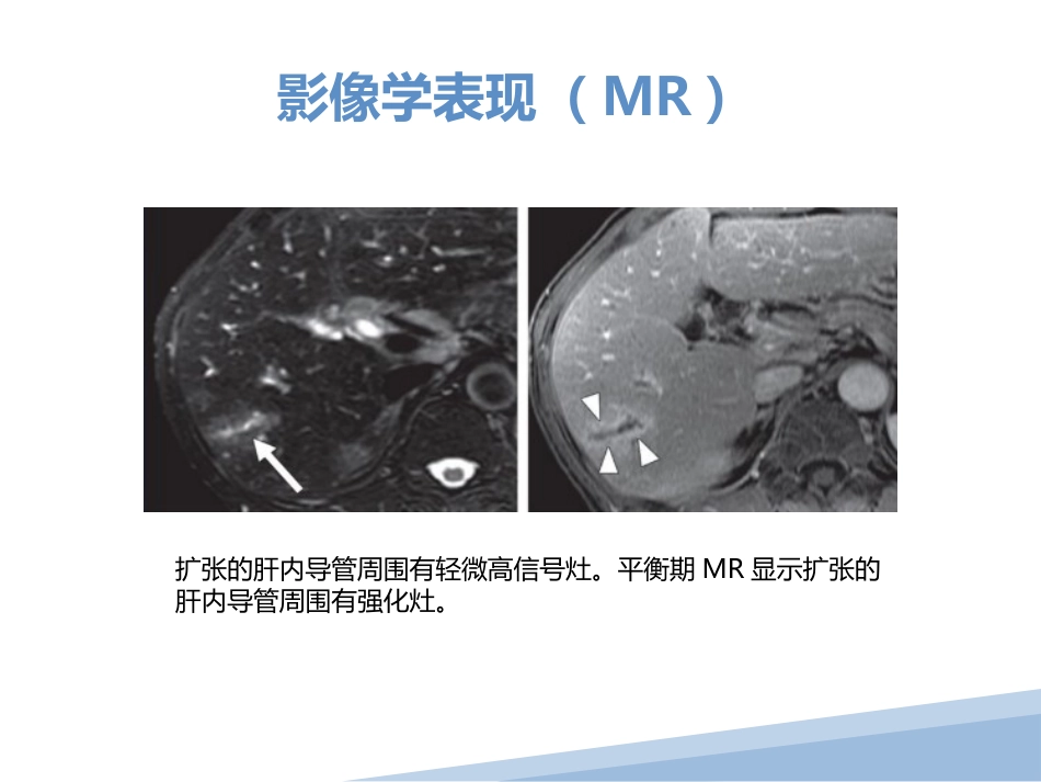 胆管细胞癌胆管癌影像诊断_第15页