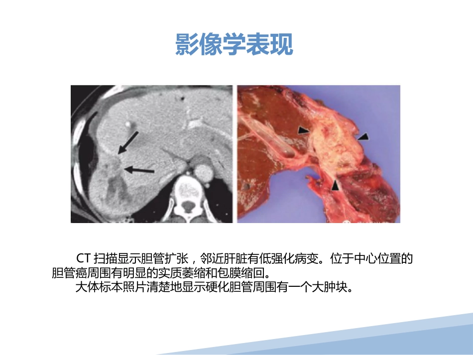胆管细胞癌胆管癌影像诊断_第8页