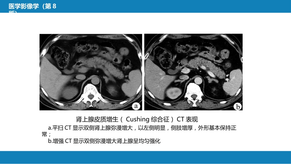 第八章 泌尿生殖系统与腹膜后间隙 第二节 肾上腺_第13页