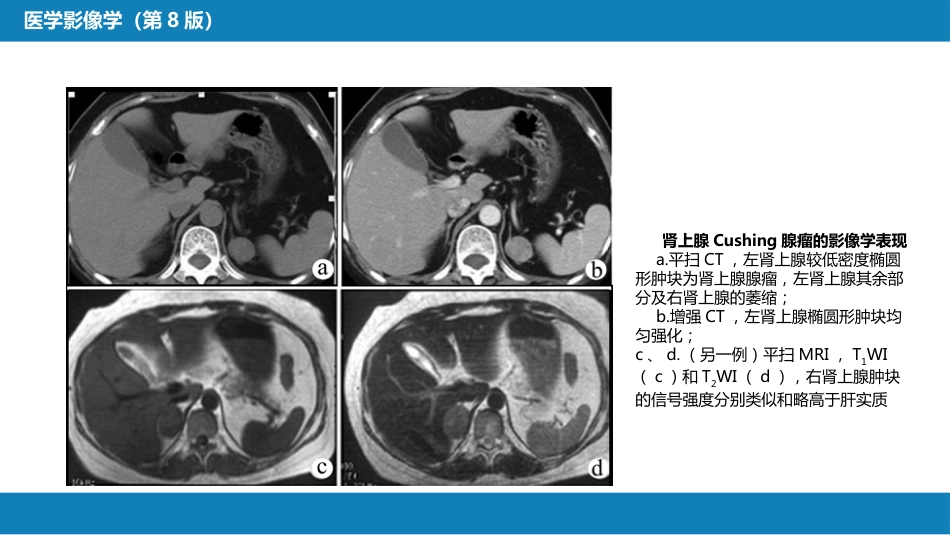 第八章 泌尿生殖系统与腹膜后间隙 第二节 肾上腺_第15页