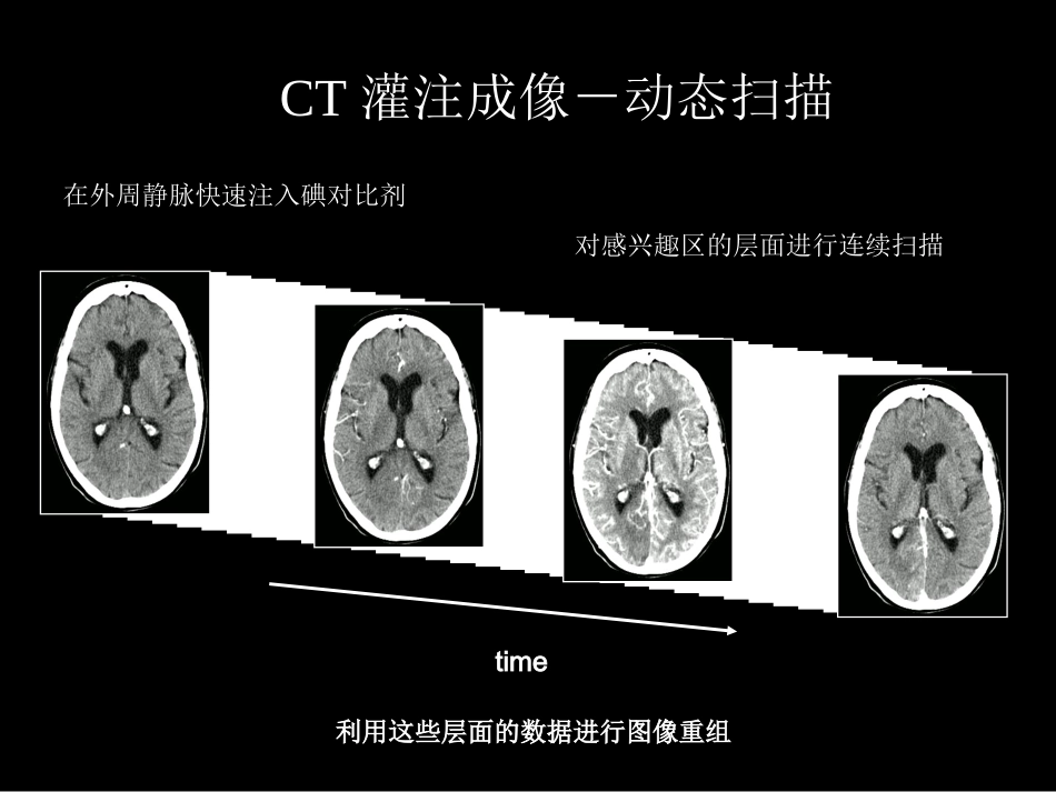脑缺血的CT、MR灌注成像_第10页