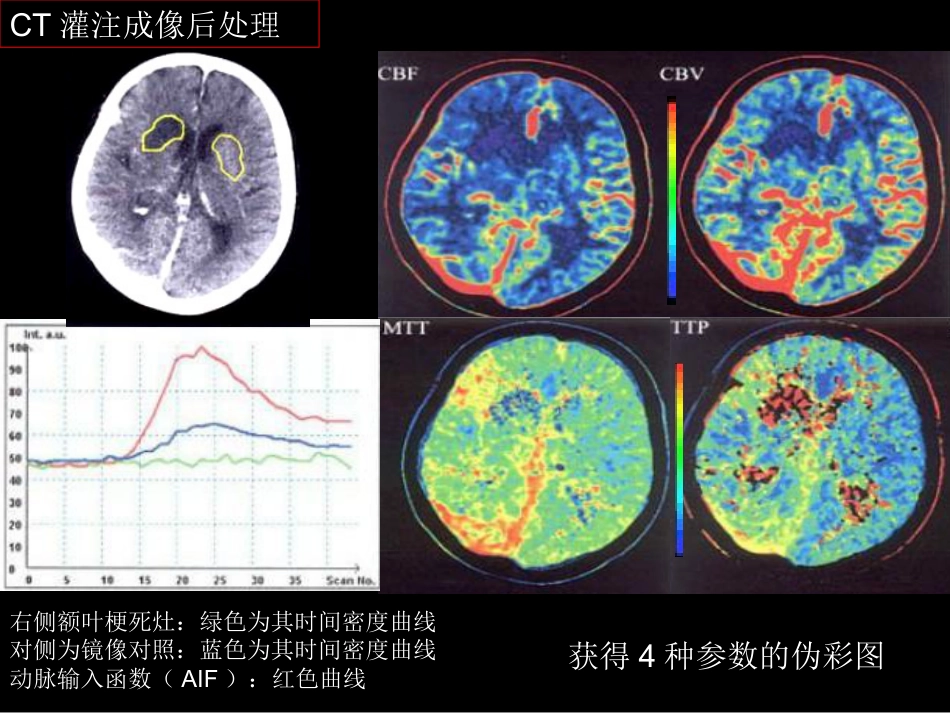 脑缺血的CT、MR灌注成像_第11页