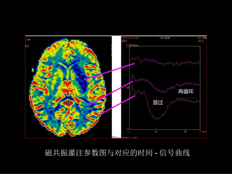脑缺血的CT、MR灌注成像_第12页