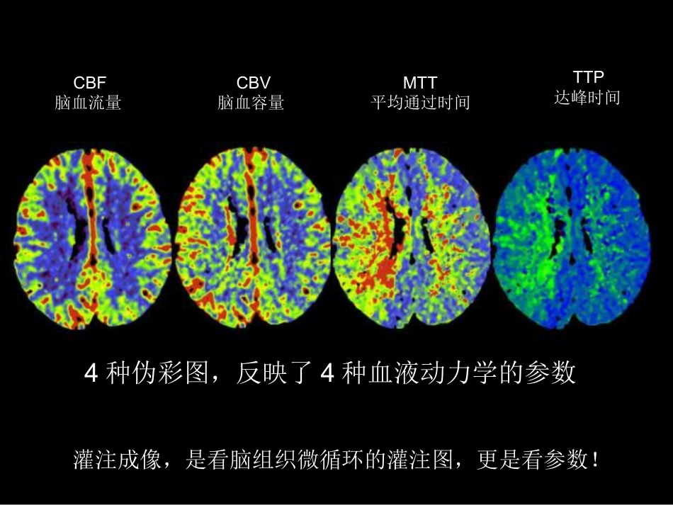 脑缺血的CT、MR灌注成像_第14页