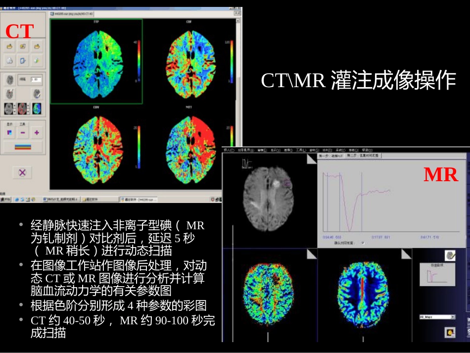 脑缺血的CT、MR灌注成像_第9页