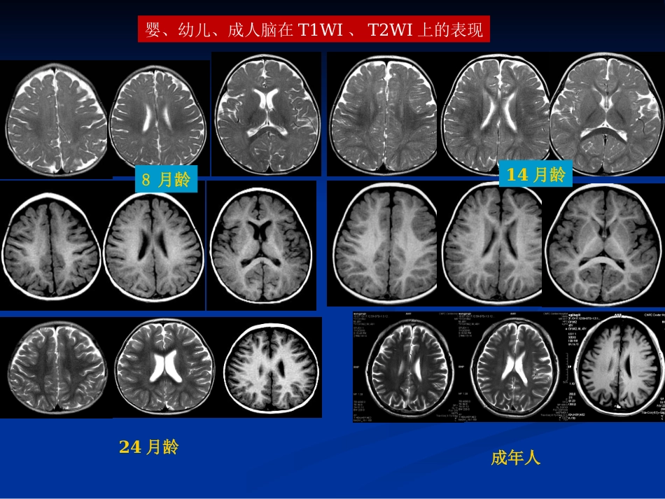 新生儿缺氧缺血性_第11页