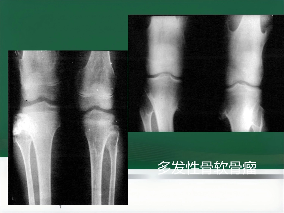 成软骨性骨肿瘤的影像学诊断_第15页