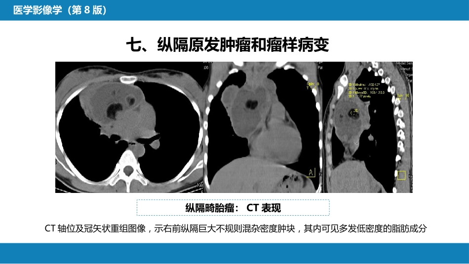 第四章 呼吸系统 第四节 疾病诊断-纵隔病变、胸膜病变、胸部外伤_第11页