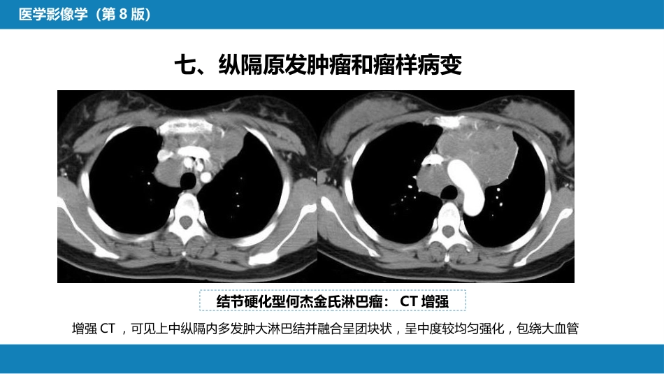 第四章 呼吸系统 第四节 疾病诊断-纵隔病变、胸膜病变、胸部外伤_第13页