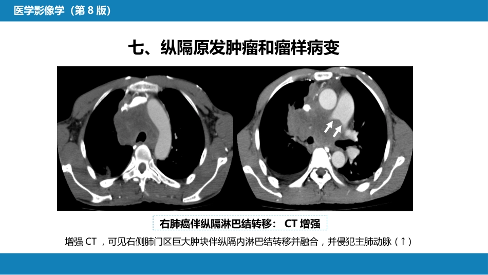 第四章 呼吸系统 第四节 疾病诊断-纵隔病变、胸膜病变、胸部外伤_第14页