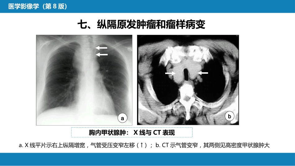 第四章 呼吸系统 第四节 疾病诊断-纵隔病变、胸膜病变、胸部外伤_第7页
