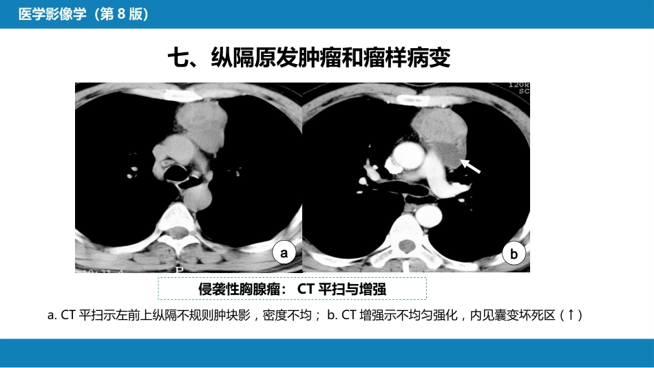 第四章 呼吸系统 第四节 疾病诊断-纵隔病变、胸膜病变、胸部外伤_第9页
