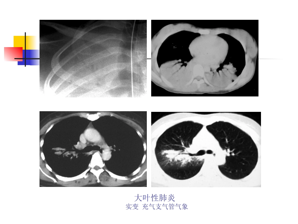 大叶性肺炎的影像诊断PPT_第12页