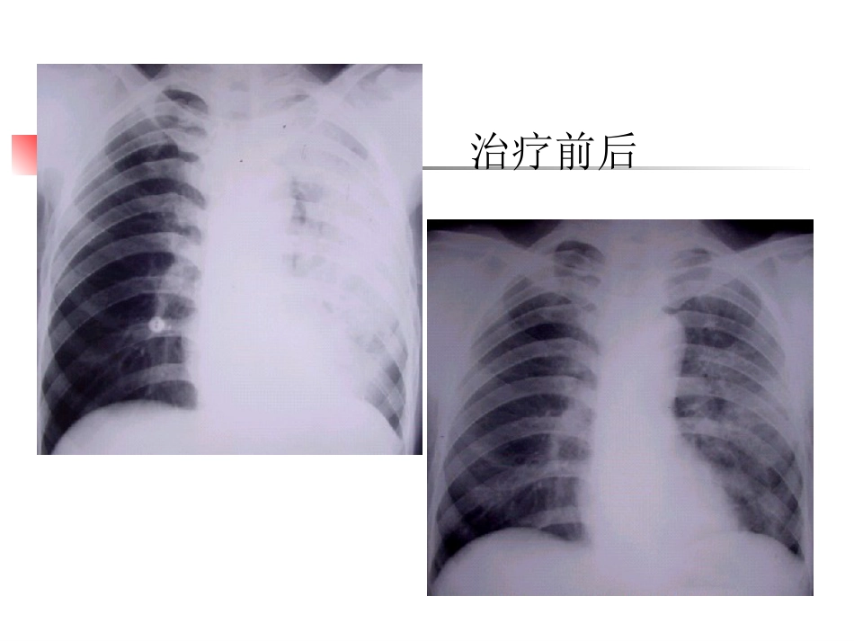大叶性肺炎的影像诊断PPT_第13页