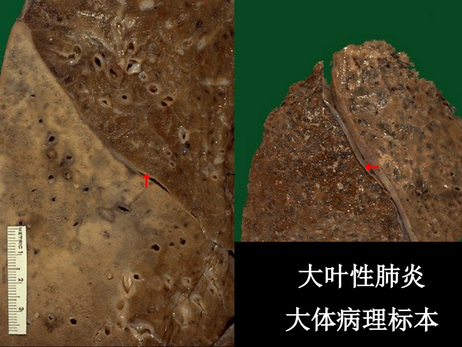 大叶性肺炎的影像诊断PPT_第5页