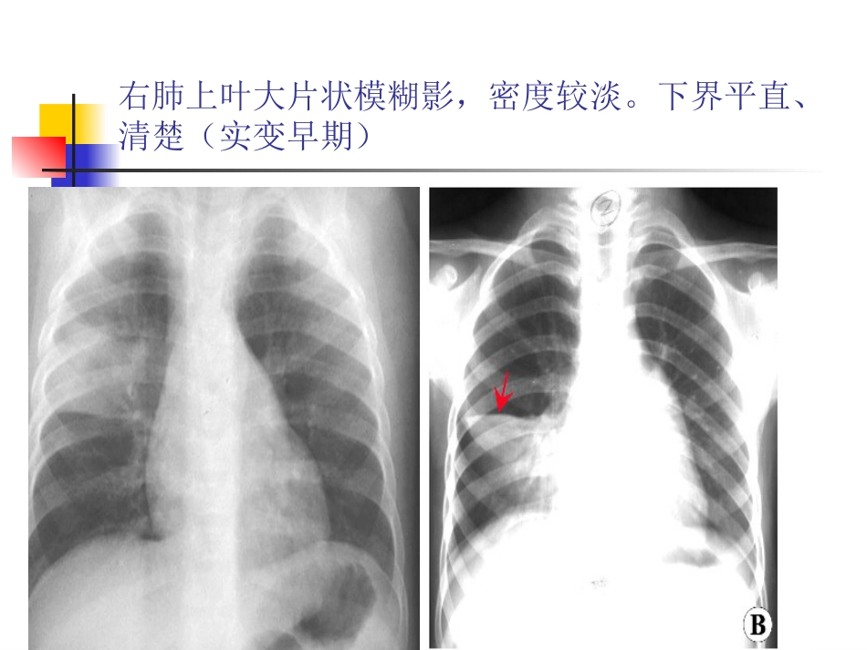 大叶性肺炎的影像诊断PPT_第7页
