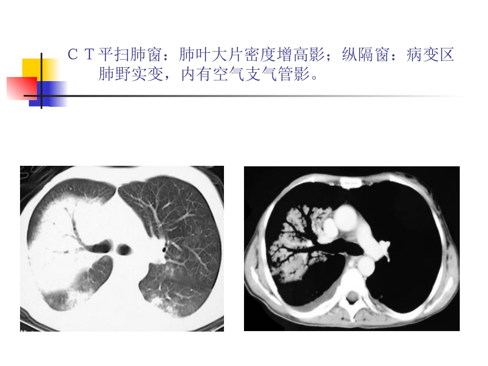 大叶性肺炎的影像诊断PPT_第8页