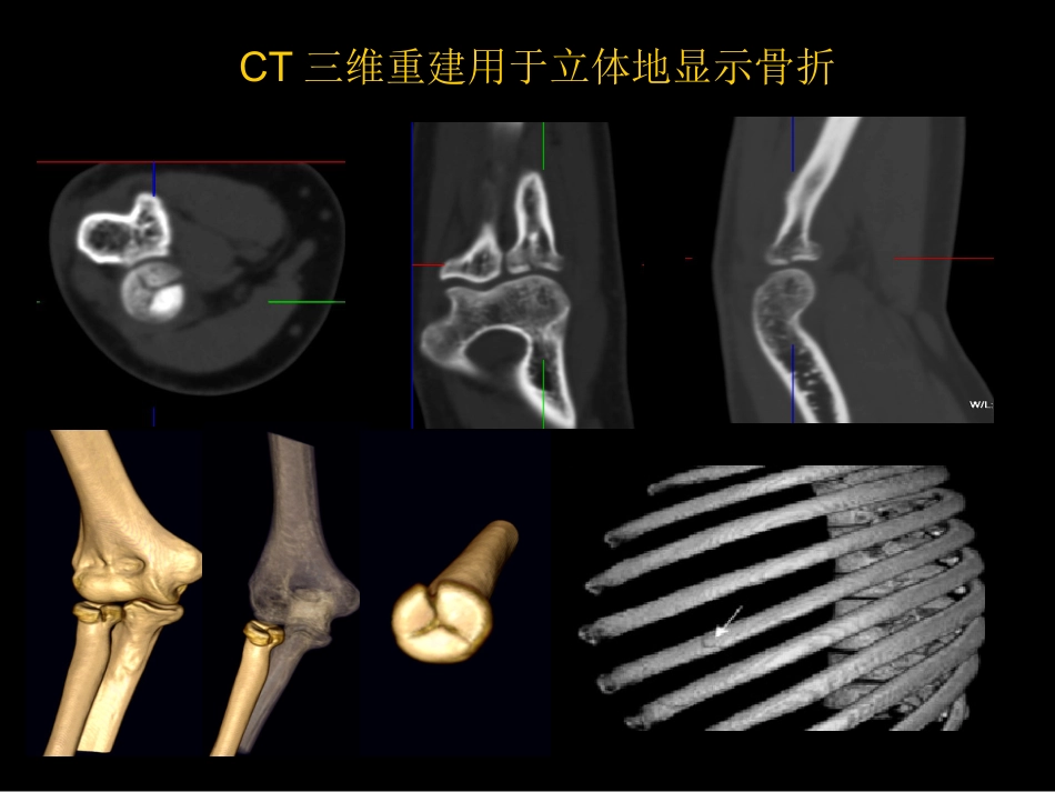 骨与关节常见病影像诊断_第11页