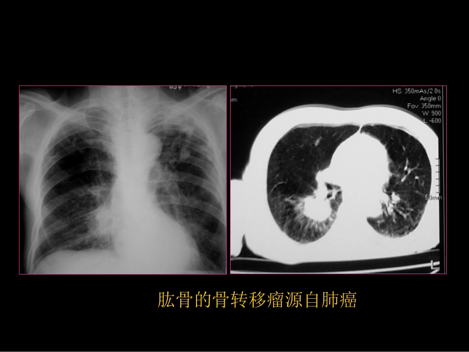 骨与关节常见病影像诊断_第15页