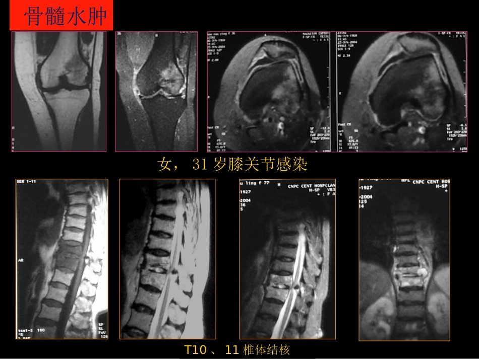 骨与关节常见病影像诊断_第6页