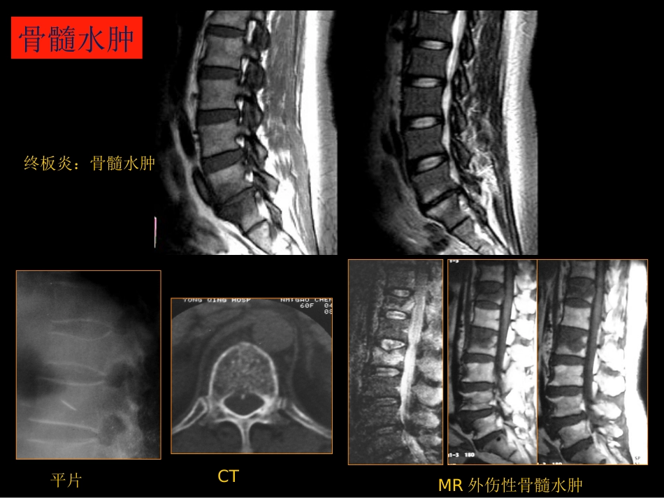 骨与关节常见病影像诊断_第8页