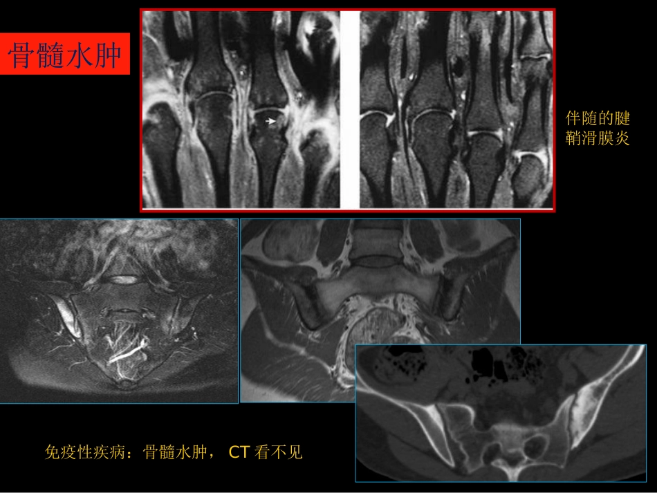 骨与关节常见病影像诊断_第9页