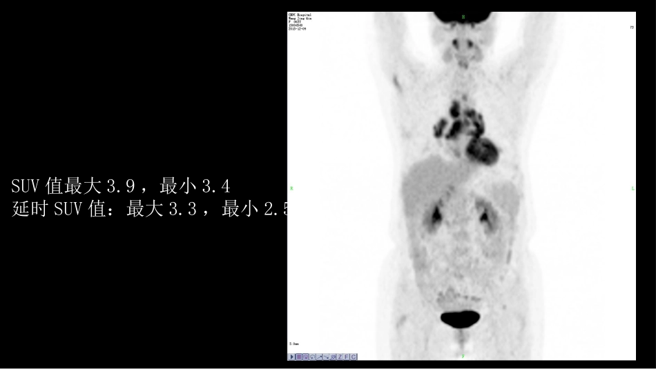 胸部结节病综合影像学交流_第10页