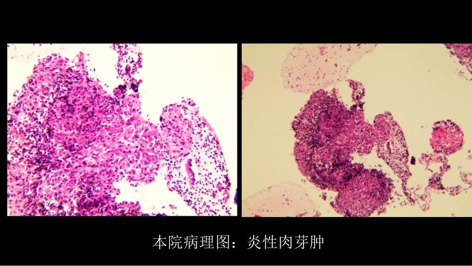 胸部结节病综合影像学交流_第12页