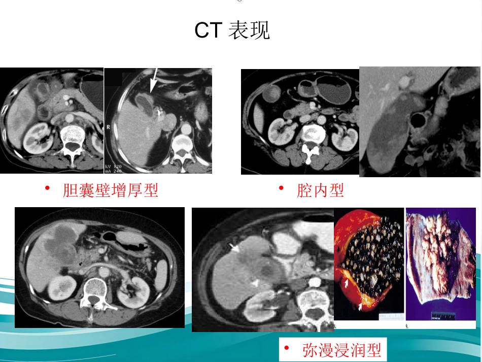 胆囊癌的影像诊断 PPT课件_第10页