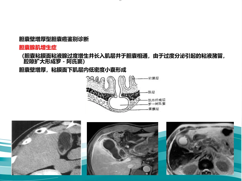 胆囊癌的影像诊断 PPT课件_第12页