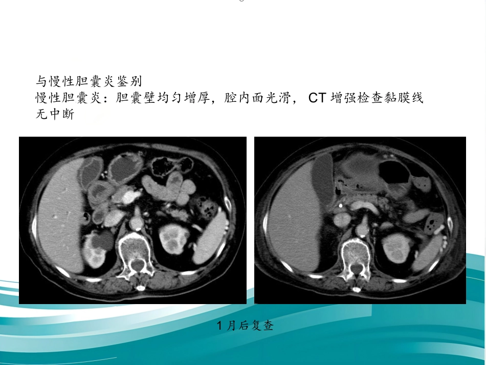胆囊癌的影像诊断 PPT课件_第13页