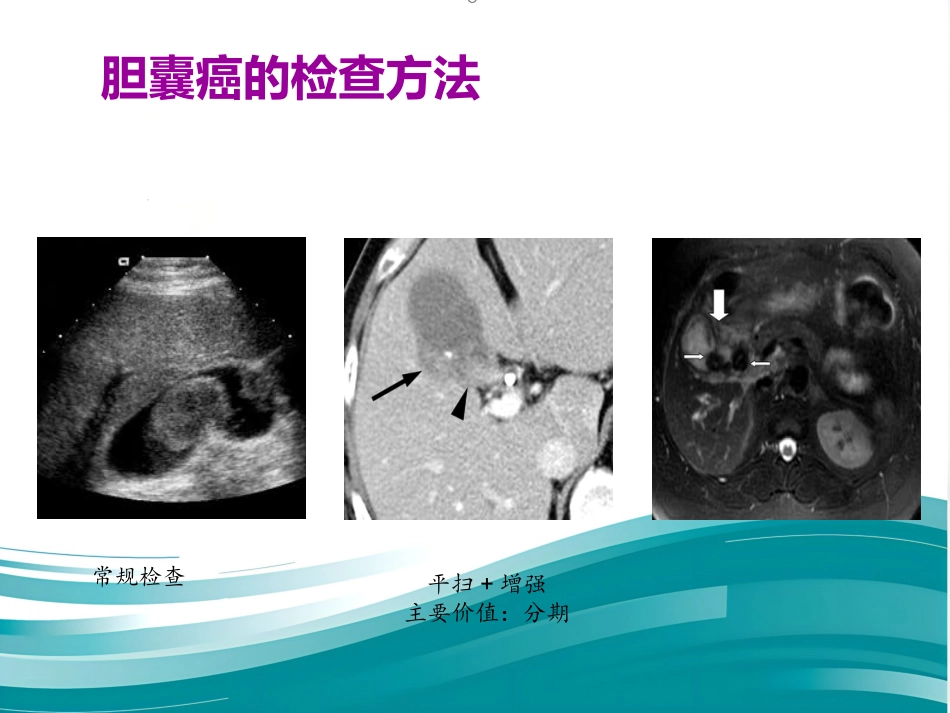 胆囊癌的影像诊断 PPT课件_第6页