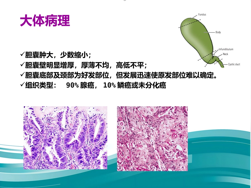 胆囊癌的影像诊断 PPT课件_第7页