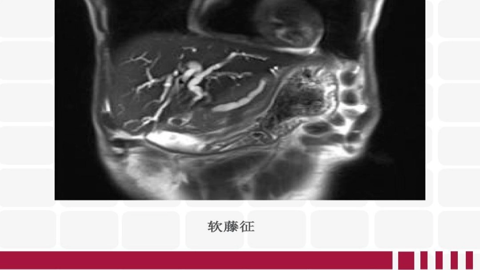 胆道梗阻相关疾病影像学表现_第15页