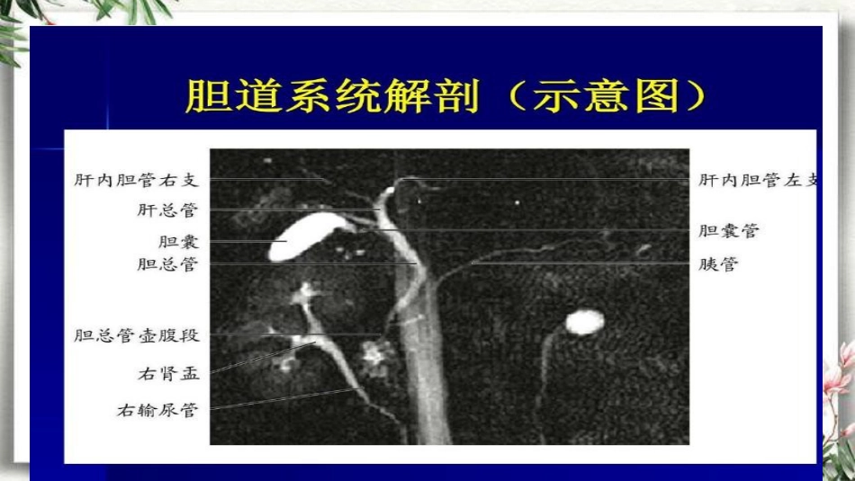 胆道梗阻相关疾病影像学表现_第5页