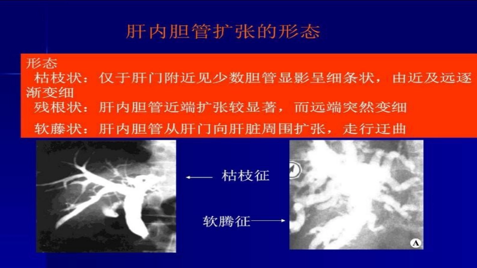 胆道梗阻相关疾病影像学表现_第9页