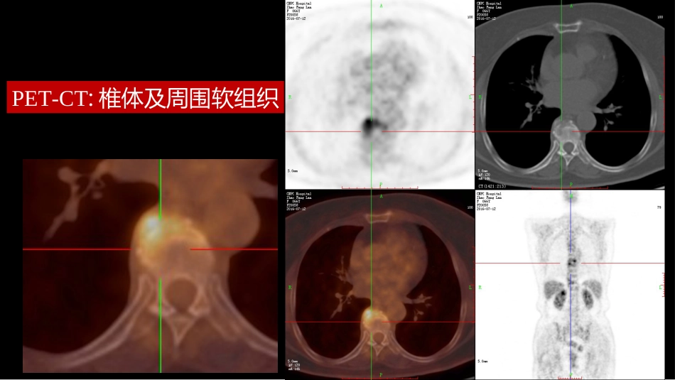椎体局灶性病变：综合影像学评判_第10页