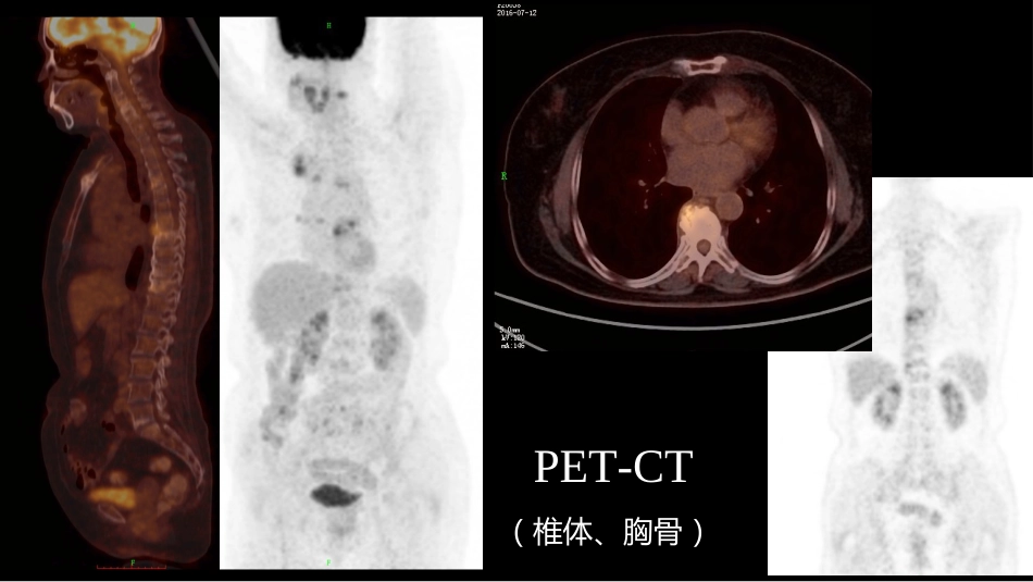 椎体局灶性病变：综合影像学评判_第11页