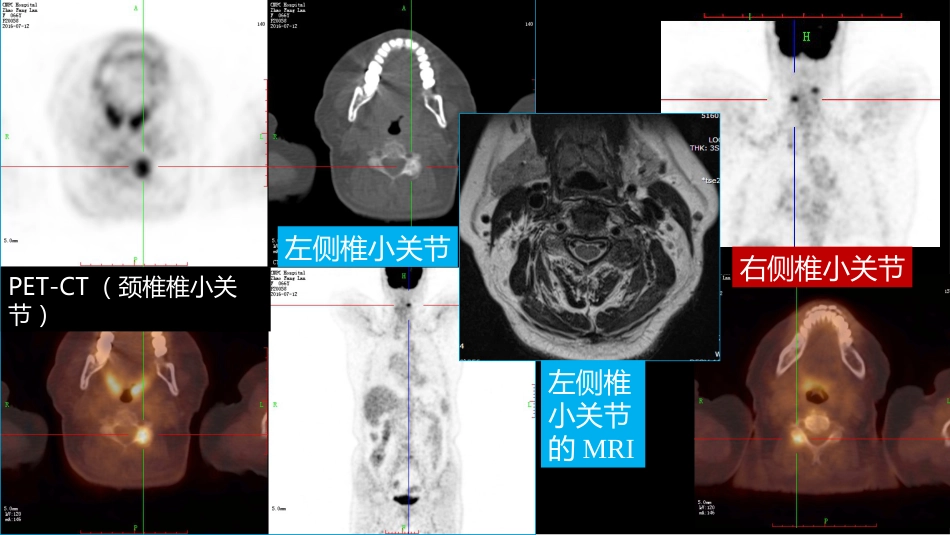 椎体局灶性病变：综合影像学评判_第12页