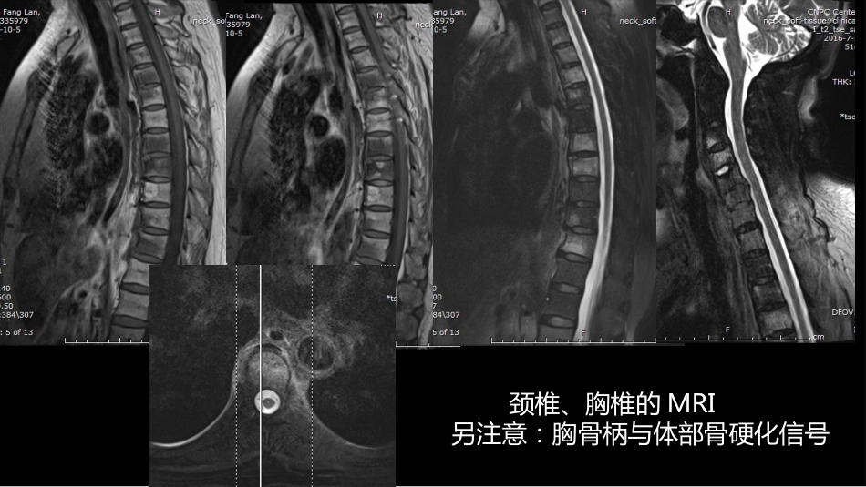 椎体局灶性病变：综合影像学评判_第3页