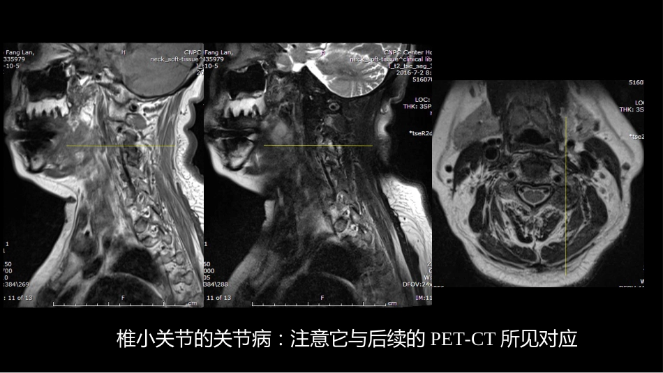 椎体局灶性病变：综合影像学评判_第4页